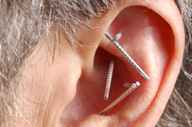 acupuncture in ear
